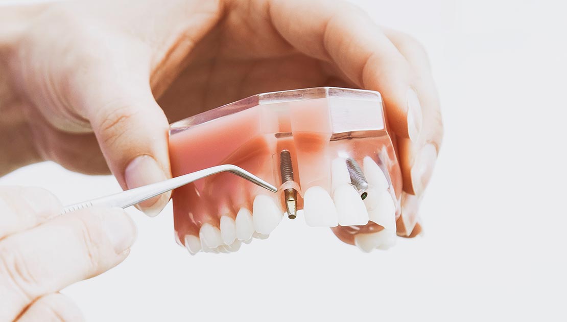 Dental Implant Process