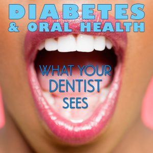 Anderson dentists, Dr. Hardy & Dr. Wilson of Cornerstone Dentistry, discusses the side effects of diabetes and how it affects your oral health.