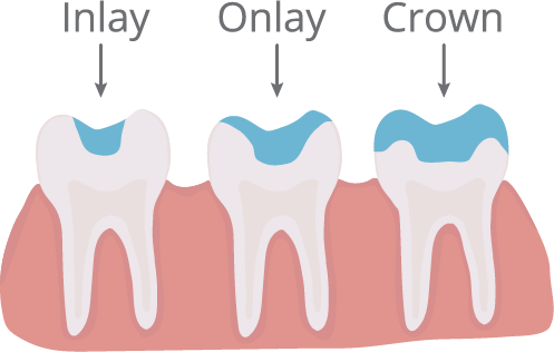 Dental Crown and Inlay and Onlay
