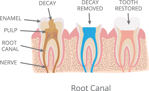 Root Canal Dentist Anderson SC