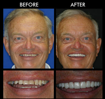 Dentures in Anderson SC