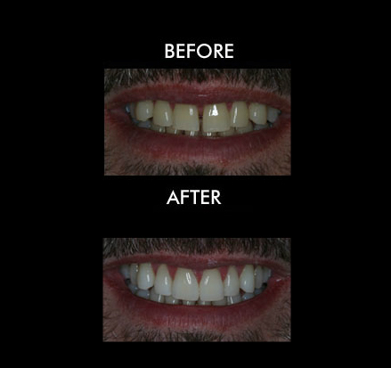 Teeth Whitening Anderson SC