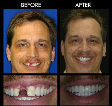 Dental Implants Anderson SC