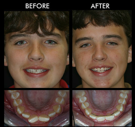 Dental Crowns Anderson SC
