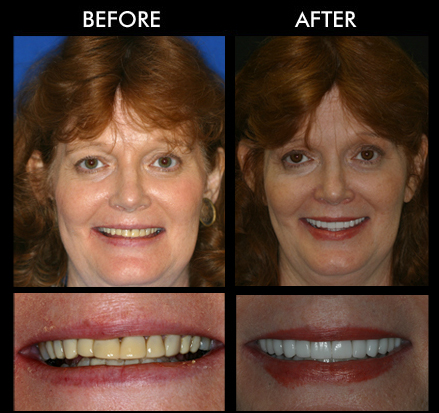 Teeth Whitening in Anderson