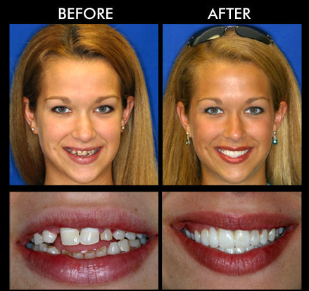 Full Teeth Replacement Anderson SC
