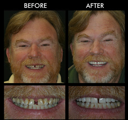Teeth Replacement Anderson SC Teeth Replacement Anderson SC