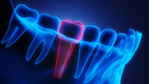 Dental Implant Dentist Anderson SC