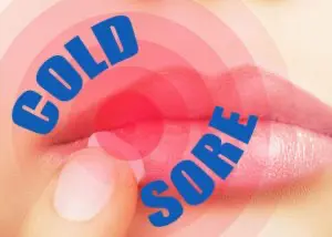 Dental Care and Cold Sores