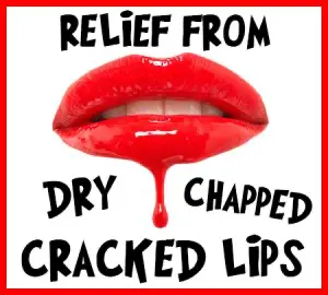 Anderson dentist, Dr. Hardy & Dr. Wilson at Cornerstone Dentistry, tells you how to relieve your dry, chapped, and cracked lips!