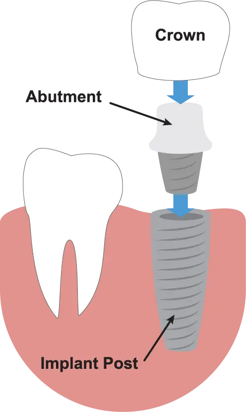 Dental Implant Anderson SC