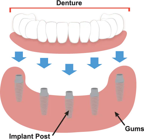 Implant Supported Dentures Anderson SC