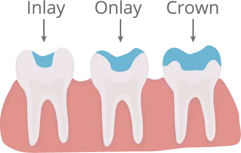 Dental Crown and Inlay and Onlay