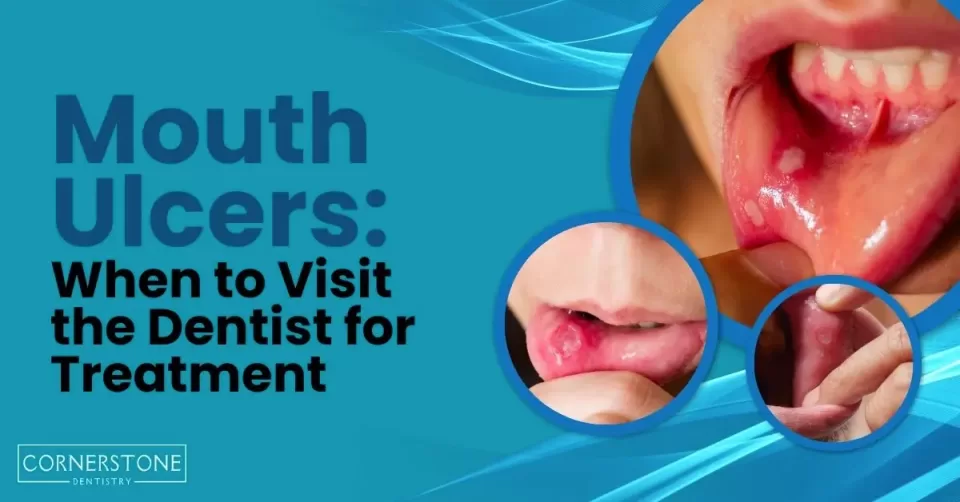 Mouth Ulcers: When to Visit the Dentist for Treatment