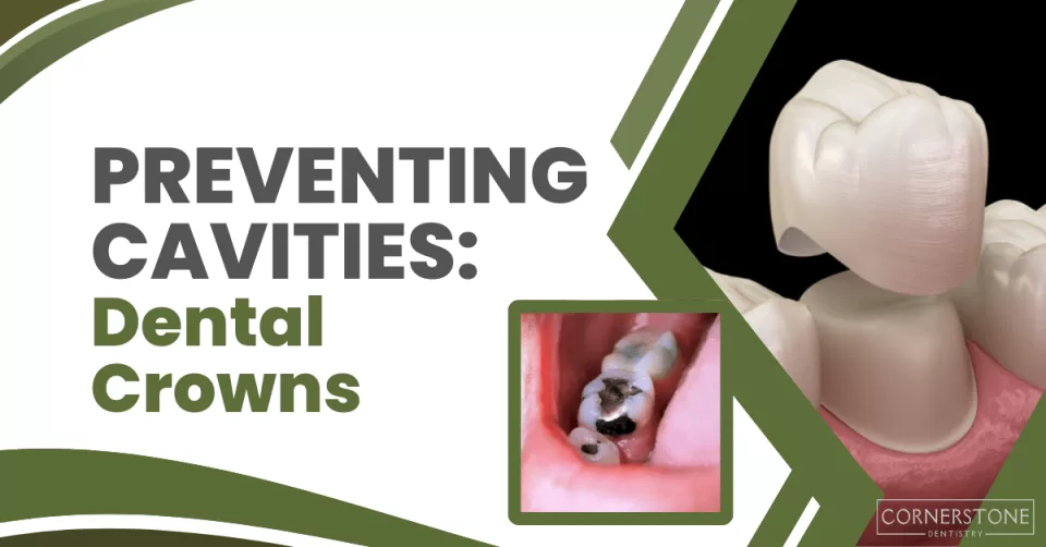Preventing Cavities: Dental Crowns