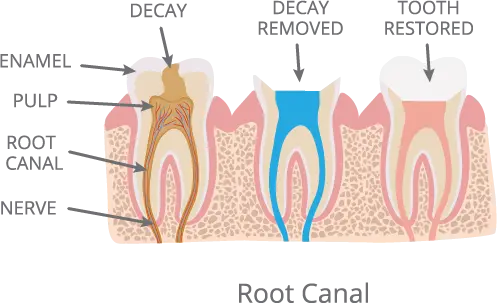 Root Canal Dentist Anderson SC