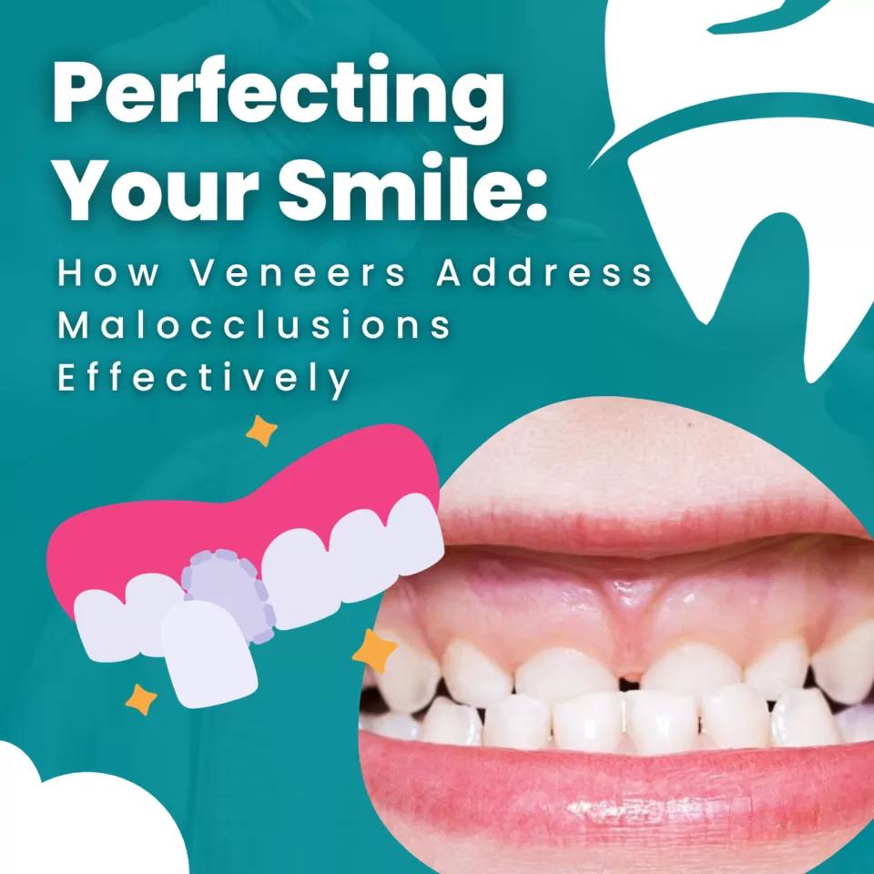 Veneers for Maloclussion - Cornerstone