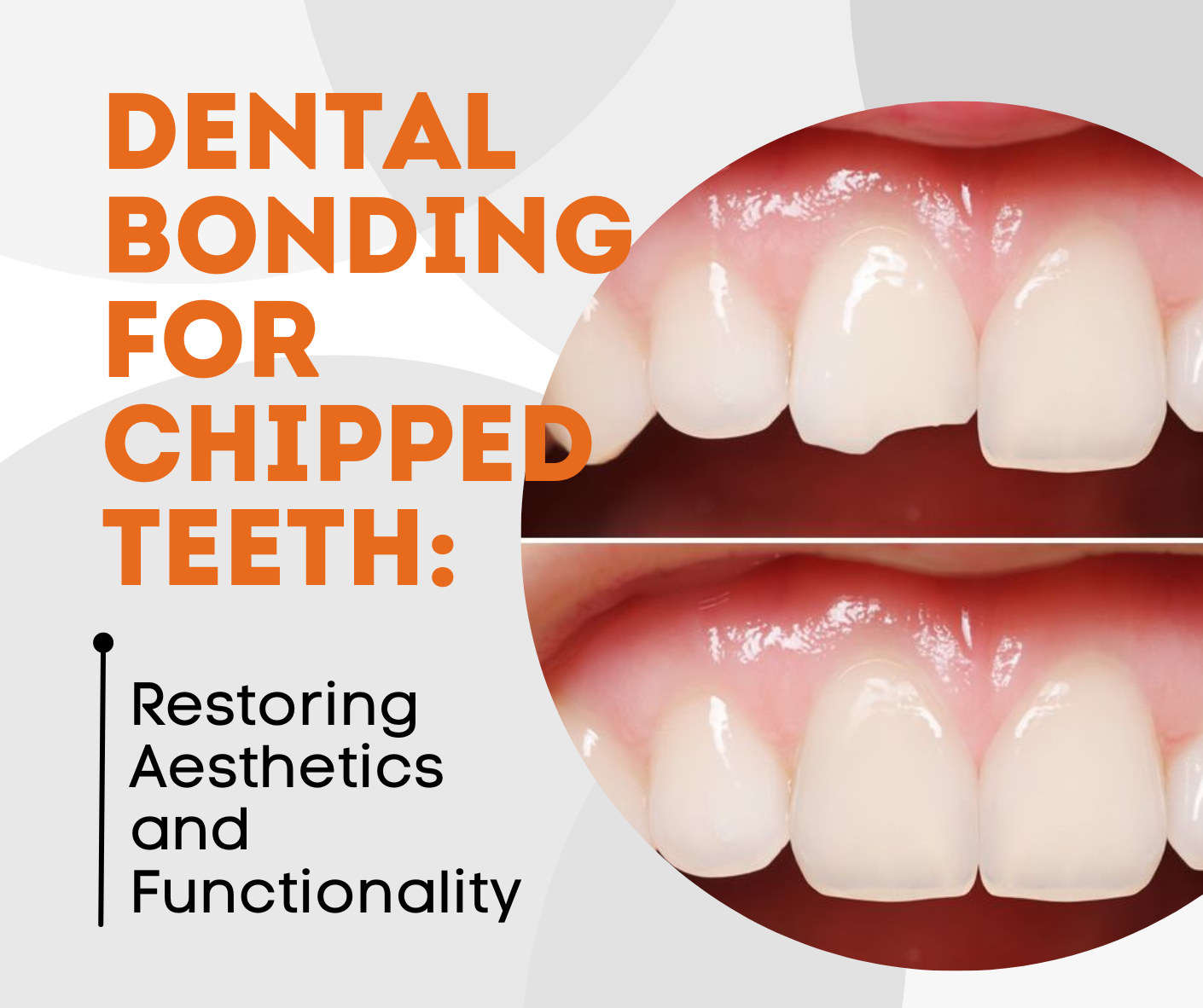 Dental bonding for chipped teeth - Cornerstone Dentistry
