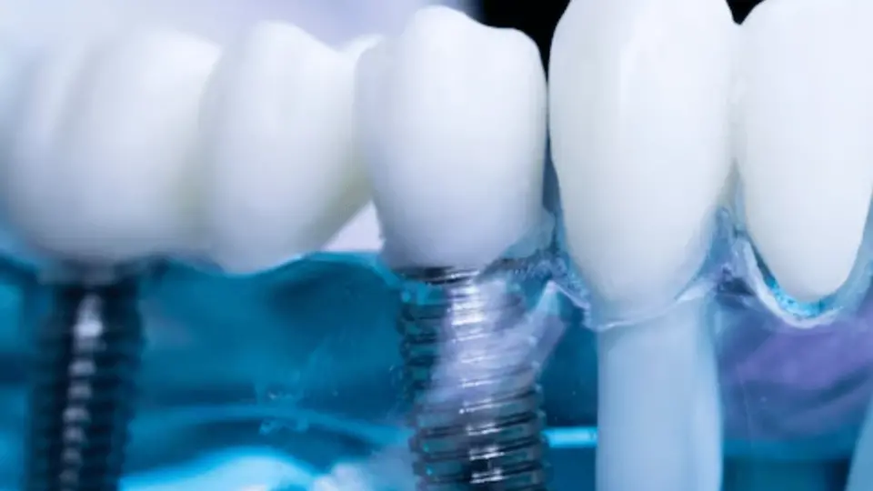 anderson sc dentist offering top notch dental implants