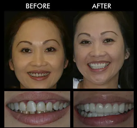 All On 4 Dental Implants