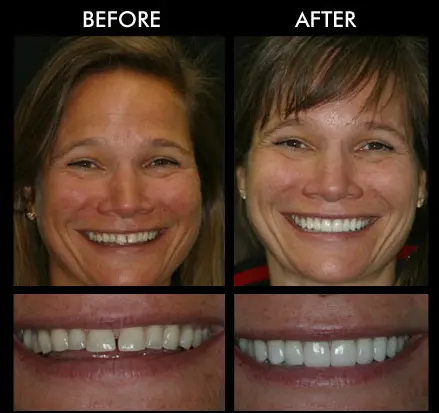 Teeth Veneers Anderson SC