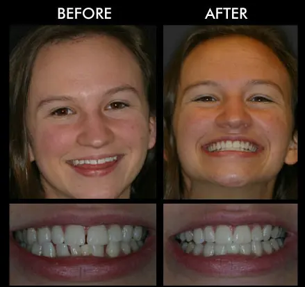 Dental Veneers Anderson SC