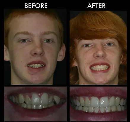 Teeth Straightening Anderson SC