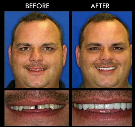 Same Day Dental Crowns