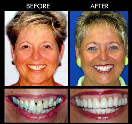 Dental Veneers in Anderson SC