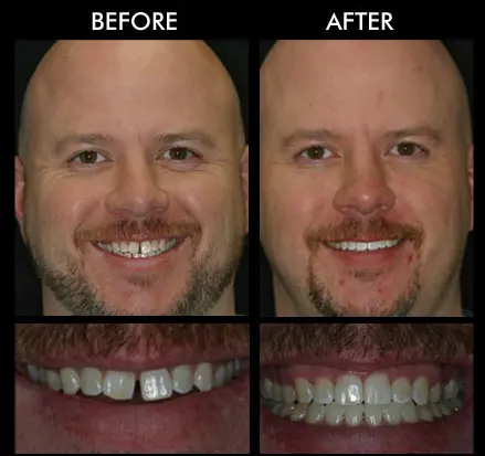 Teeth Straightening Near Me