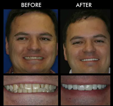 Cracked Tooth Repair Anderson SC