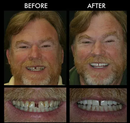 Teeth Replacement Anderson SC