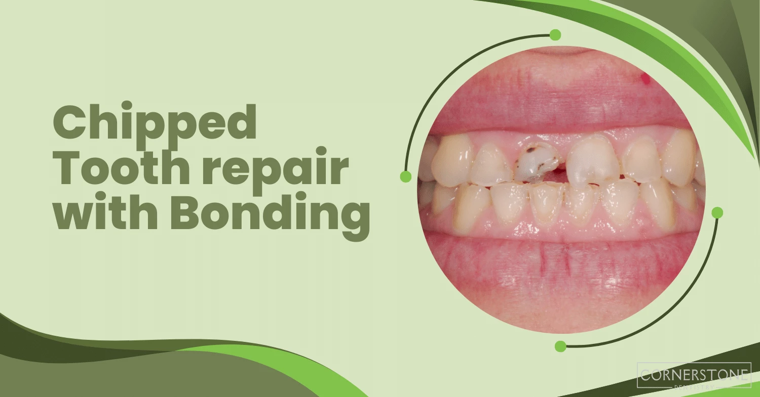 chipped tooth repair with bonding