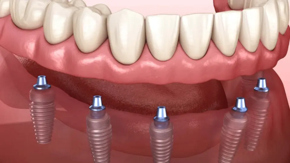 comprehensive restoration with full arch dental implants in restorative dentistry