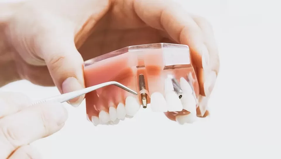 Dental Implants - Dentist Anderson SC