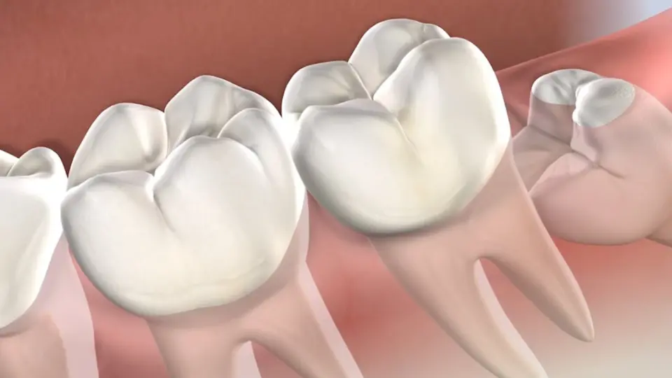 surgical interventions for treating an infected wisdom tooth