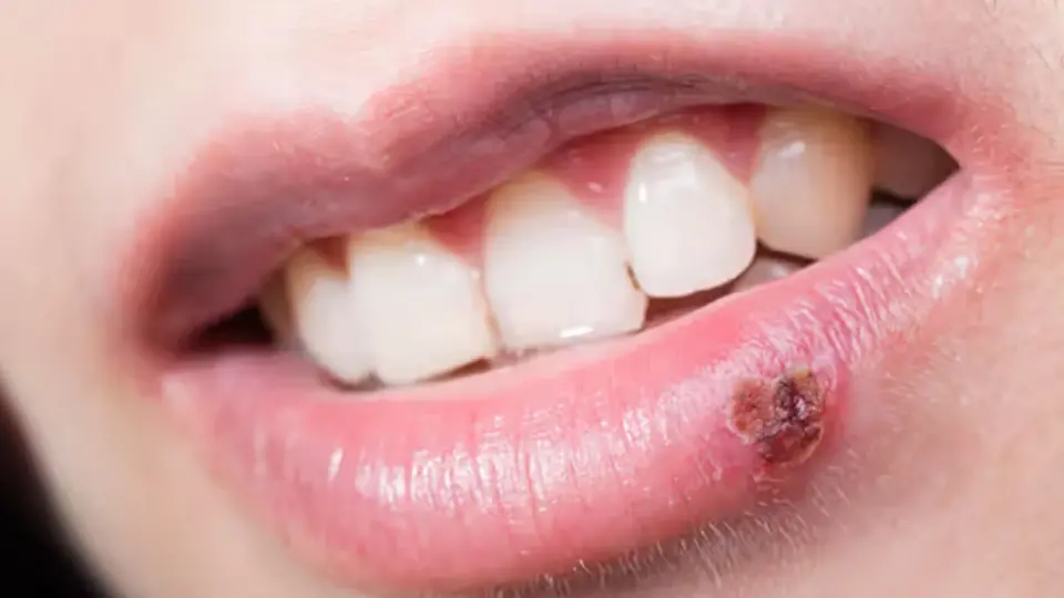 urgent management of permanent cold sores in emergency dentistry 1